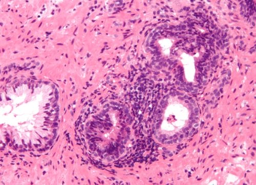 Inflammation_of_prostate
